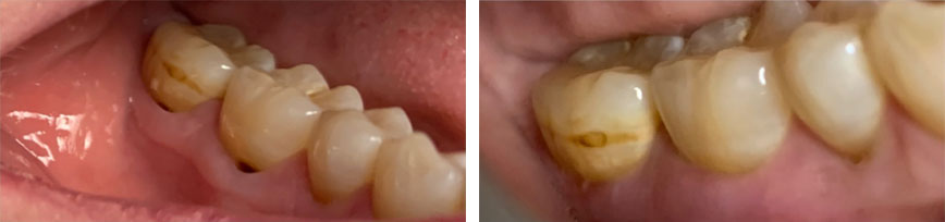 Connective Tissue Graft Photo